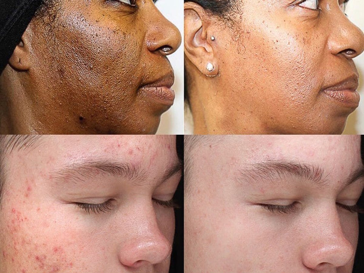 Chemical Peels